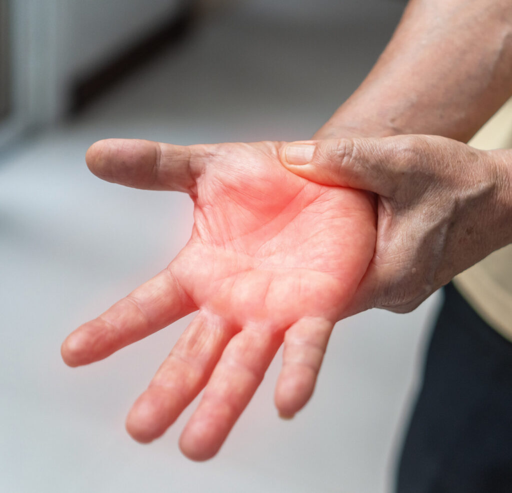 Mann hält sich die Hand, weil er an Polyneuropathie leidet, das sich unter anderem durch ein Kribbeln in den Händen zeigt.
